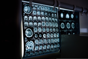 AI healthcare